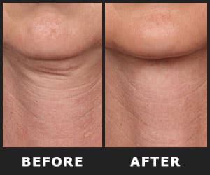 Improves Skin Firmness - INS2003